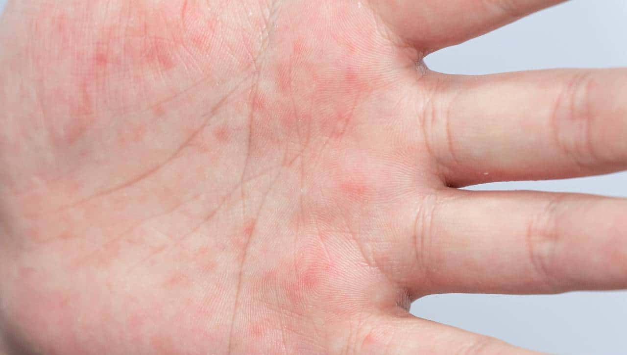 警惕！老年带状疱疹不止是疼，3大致命并发症要当心