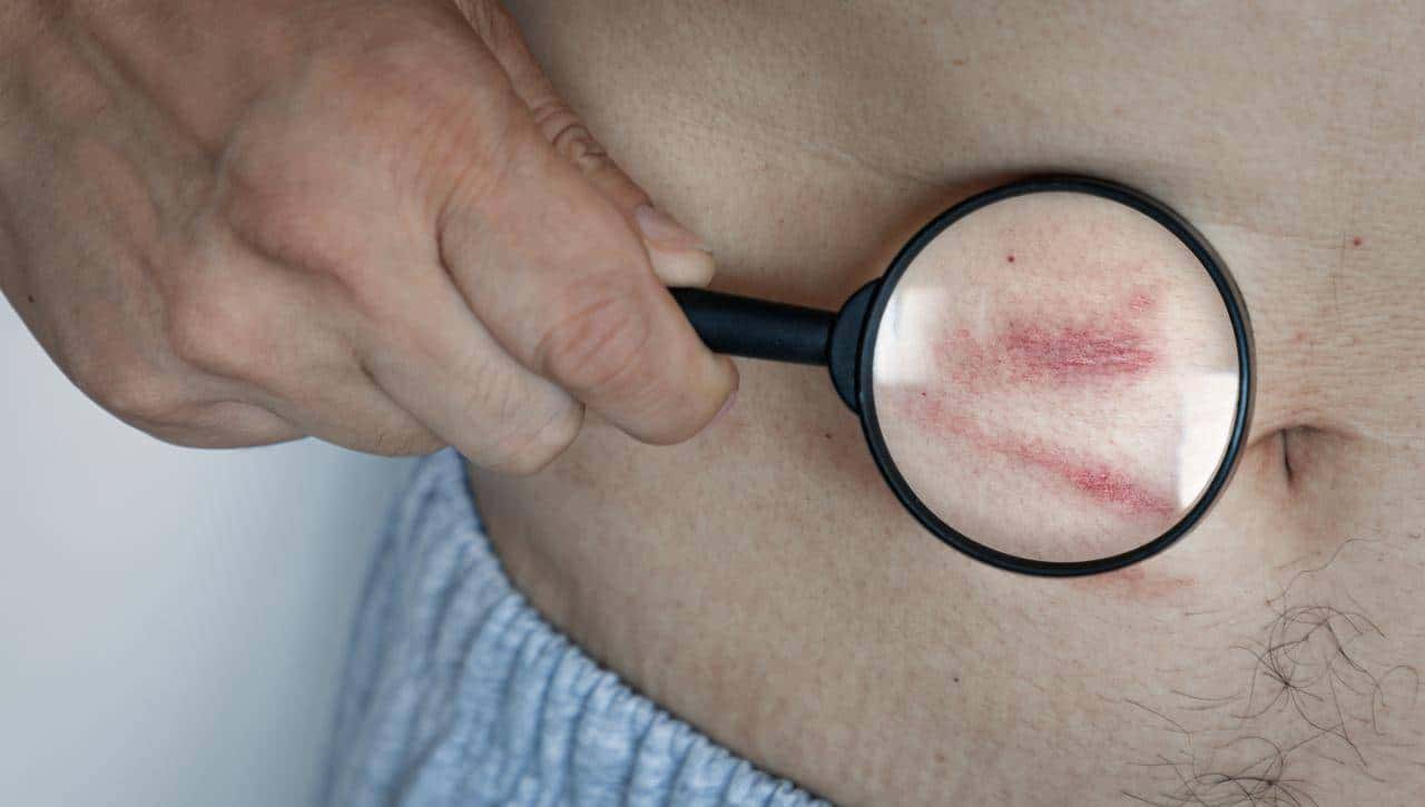 警惕！老年带状疱疹不止是疼，3大致命并发症要当心