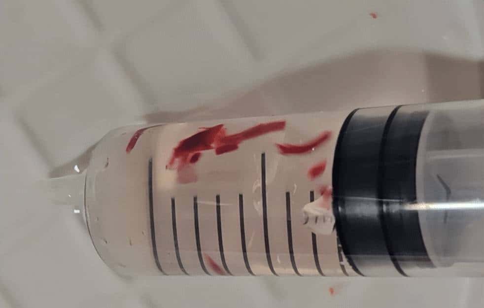 输液时抽出“虾线”状血条，是血栓吗？！我还有救吗……