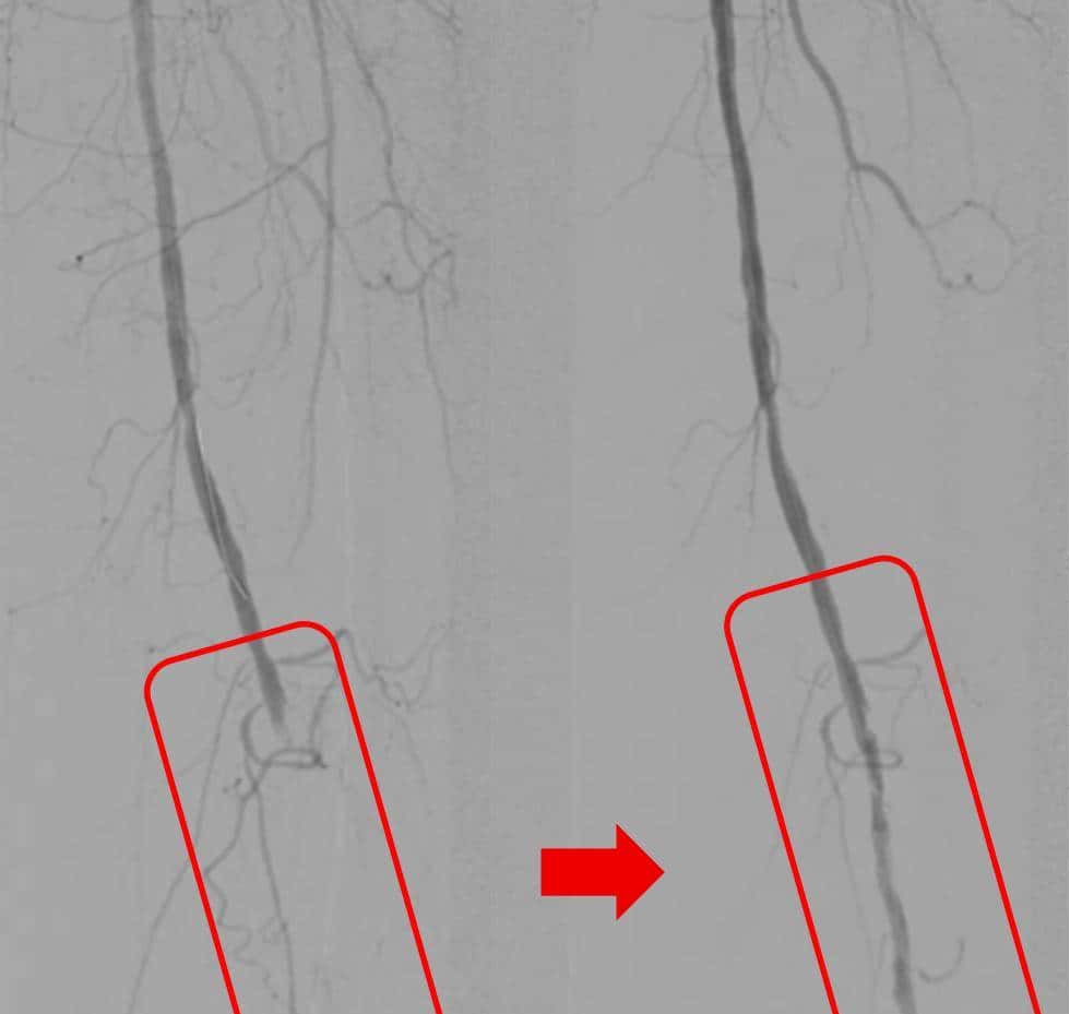 输液时抽出“虾线”状血条，是血栓吗？！我还有救吗……
