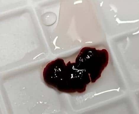 输液时抽出“虾线”状血条，是血栓吗？！我还有救吗……