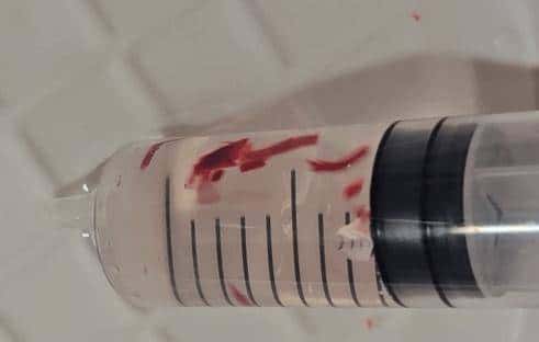 输液时抽出“虾线”状血条!?我还有救吗……