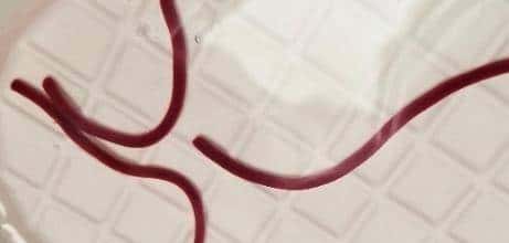 输液时抽出“虾线”状血条!?我还有救吗……