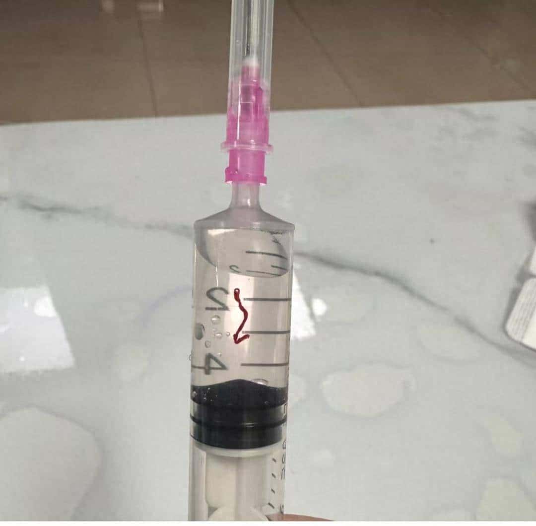 输液时抽出“虾线”状血条!?我还有救吗……