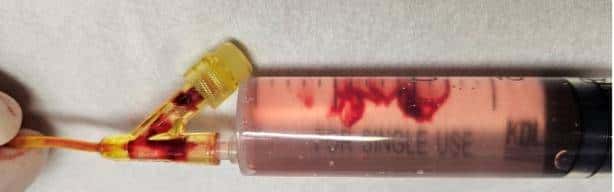 输液时抽出“虾线”状血条!?我还有救吗……