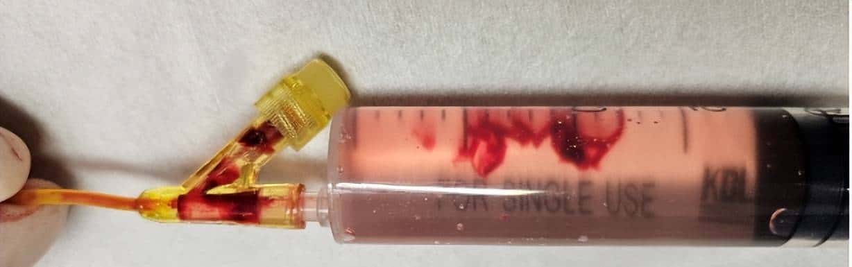 输液时抽出“虾线”状血条，是血栓吗？！我还有救吗……