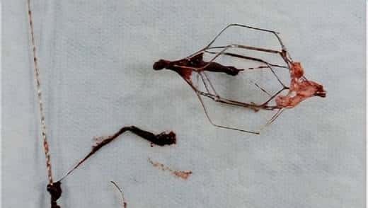 输液时抽出“虾线”状血条，是血栓吗？！我还有救吗……