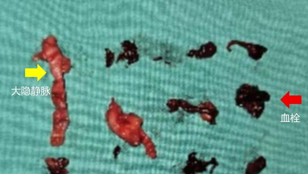 输液时抽出“虾线”状血条!?我还有救吗……