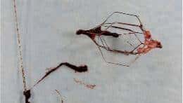 输液时抽出“虾线”状血条!?我还有救吗……