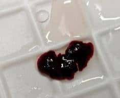 输液时抽出“虾线”状血条!?我还有救吗……