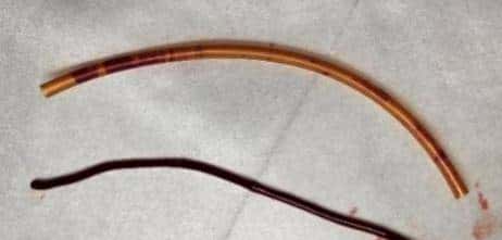 输液时抽出“虾线”状血条!?我还有救吗……