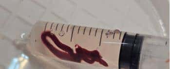 输液时抽出“虾线”状血条!?我还有救吗……