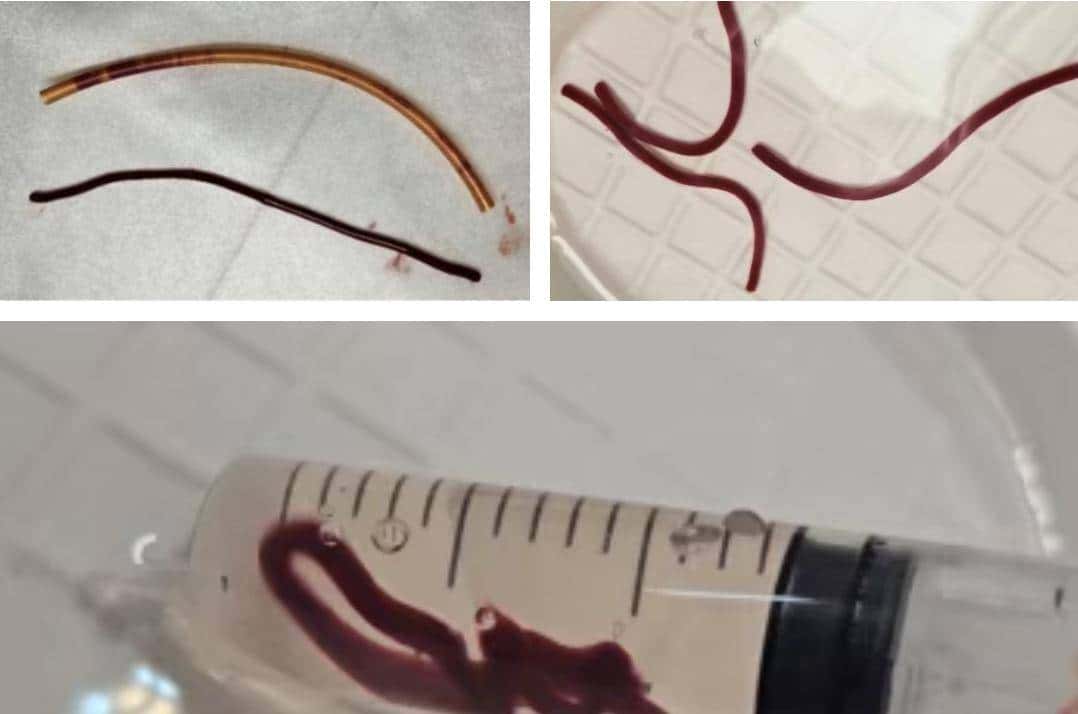 输液时抽出“虾线”状血条，是血栓吗？！我还有救吗……