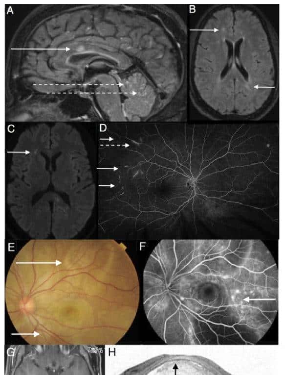 “眼+耳+脑”综合征有哪些？