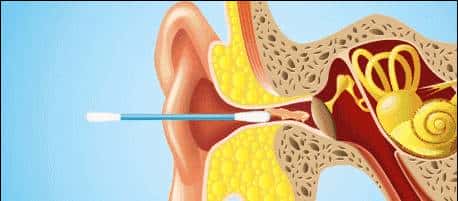 讲讲怎样给娃清理耳屎、啥时要去医院等，做到遇屎不乱