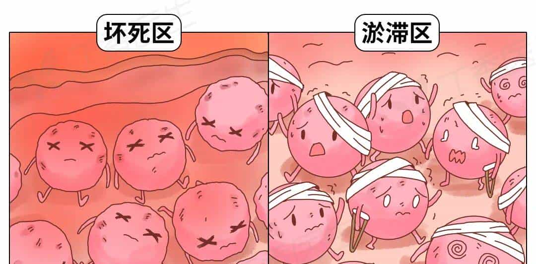 烫伤急救的 5 个步骤，许多人第一步就错了！（内附正确方法