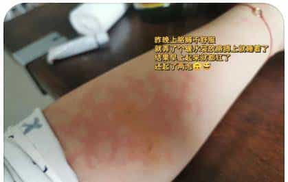 烫伤急救的 5 个步骤，许多人第一步就错了！（内附正确方法