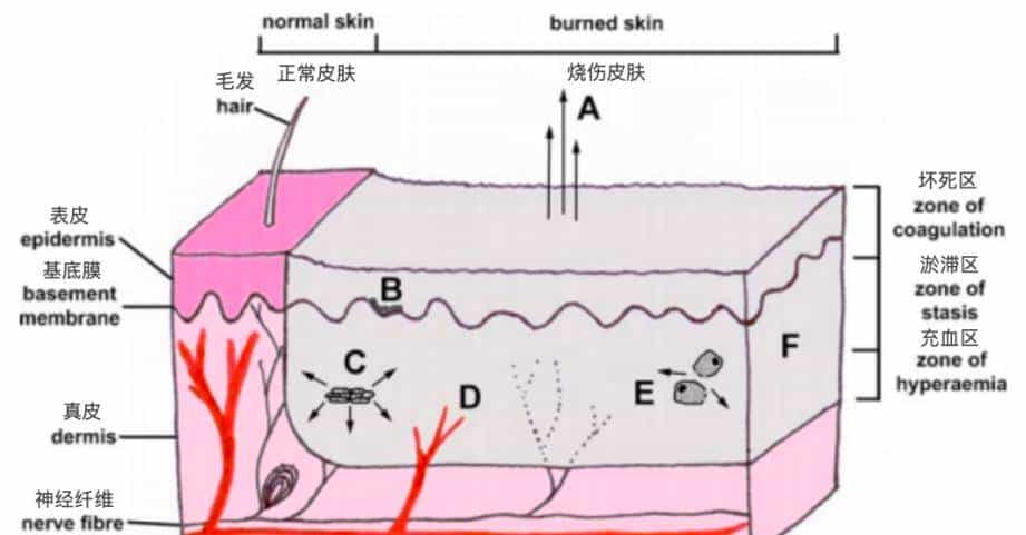 烫伤急救的 5 个步骤，许多人第一步就错了！（内附正确方法
