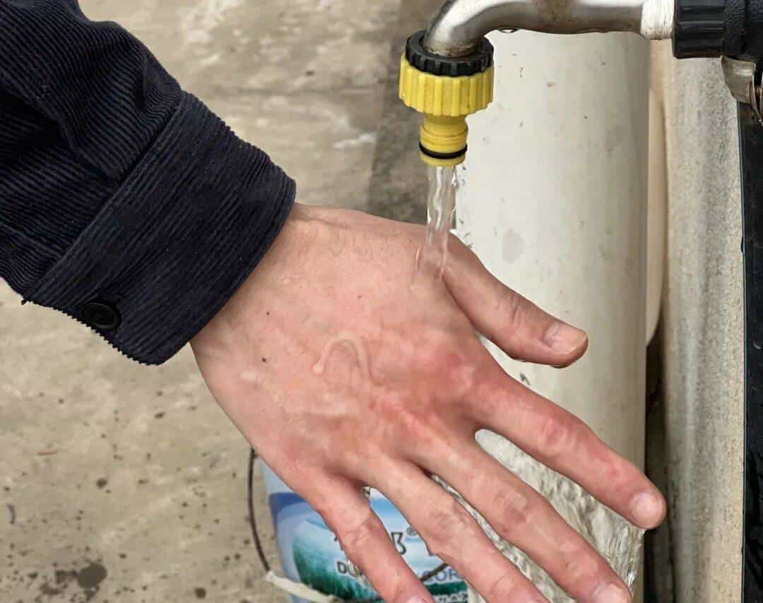 烫伤急救的 5 个步骤，许多人第一步就错了！（内附正确方法