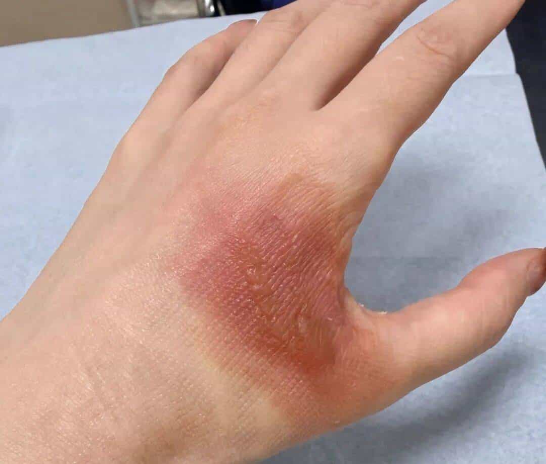 烫伤急救的 5 个步骤，许多人第一步就错了！（内附正确方法