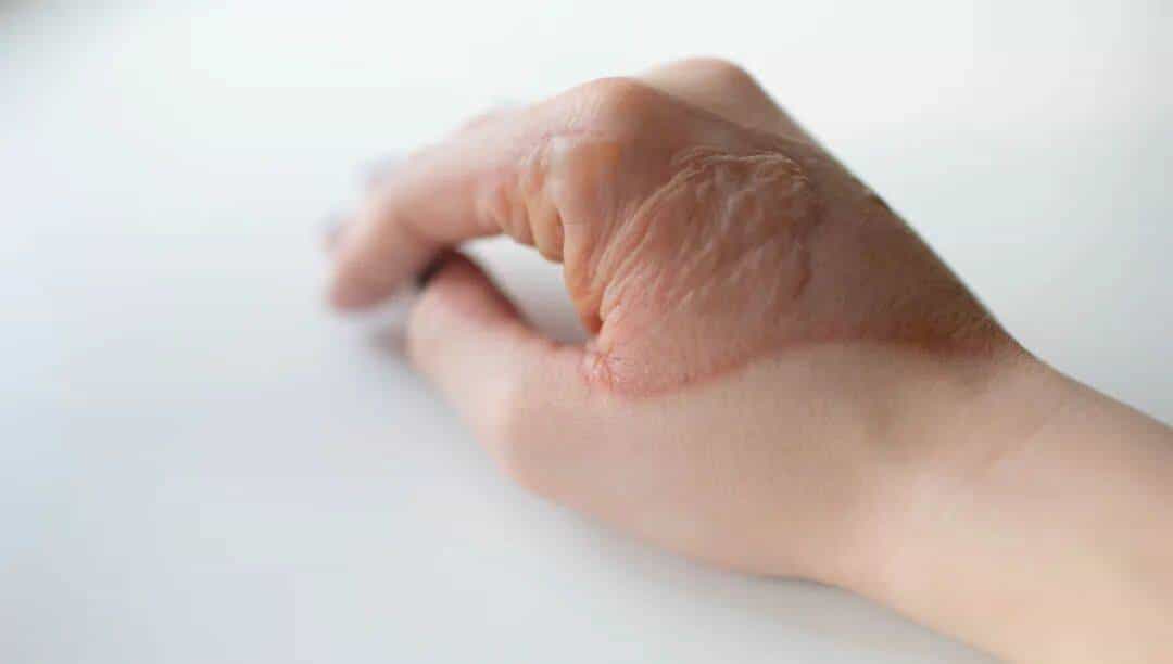 烫伤急救的 5 个步骤，许多人第一步就错了！（内附正确方法