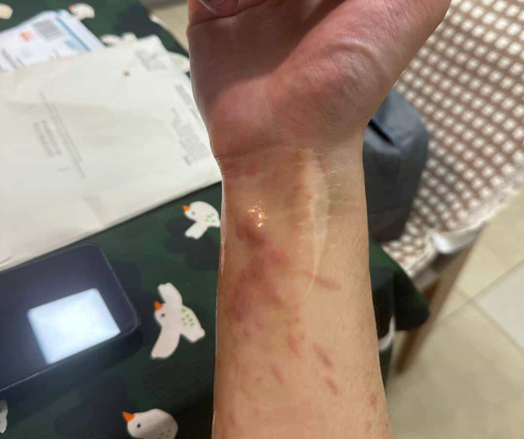 烫伤急救的 5 个步骤，许多人第一步就错了！（内附正确方法