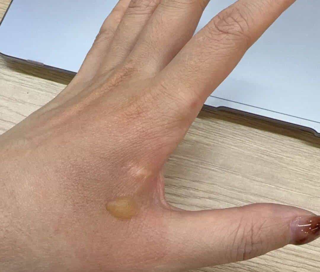 烫伤急救的 5 个步骤，许多人第一步就错了！（内附正确方法