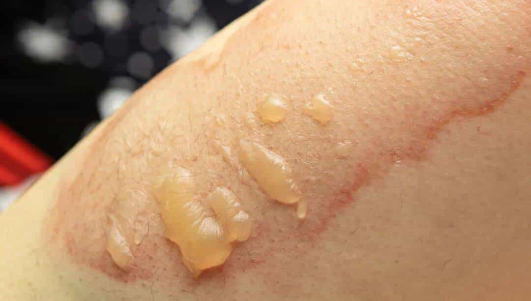 烫伤急救的 5 个步骤，许多人第一步就错了！（内附正确方法