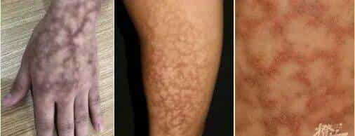 烫伤急救的 5 个步骤，许多人第一步就错了！（内附正确方法