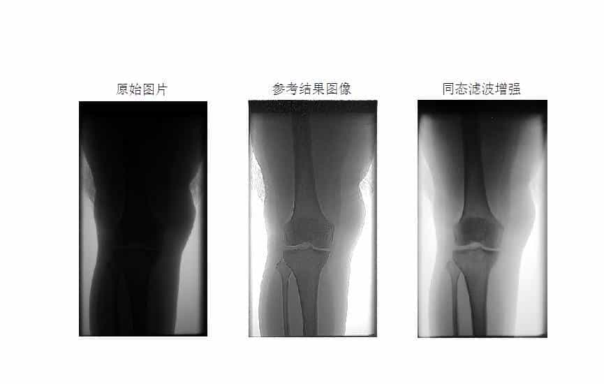 MATLAB环境下使用同态滤波方法进行医学图像增强
