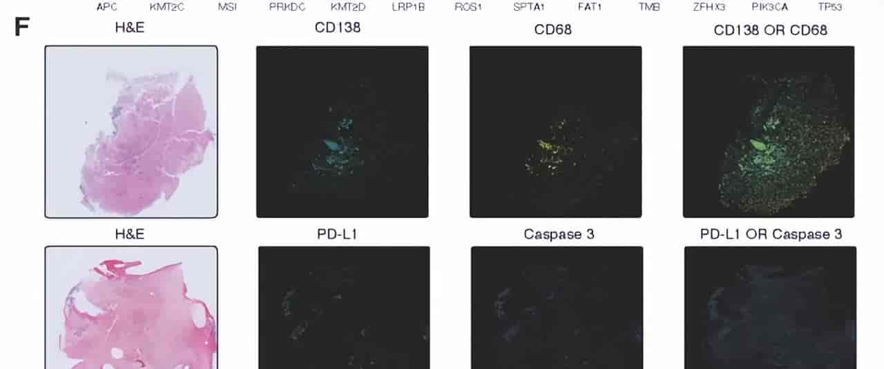 Cell重磅！微软开源首个AI肿瘤免疫模型，一键看穿癌症底细！