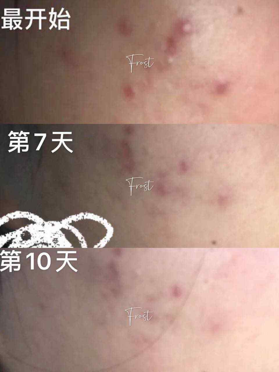 奕森祛痘精华液修颜源码20ml仪痤疮粉刺黑头痘印弈森水凝胶正品