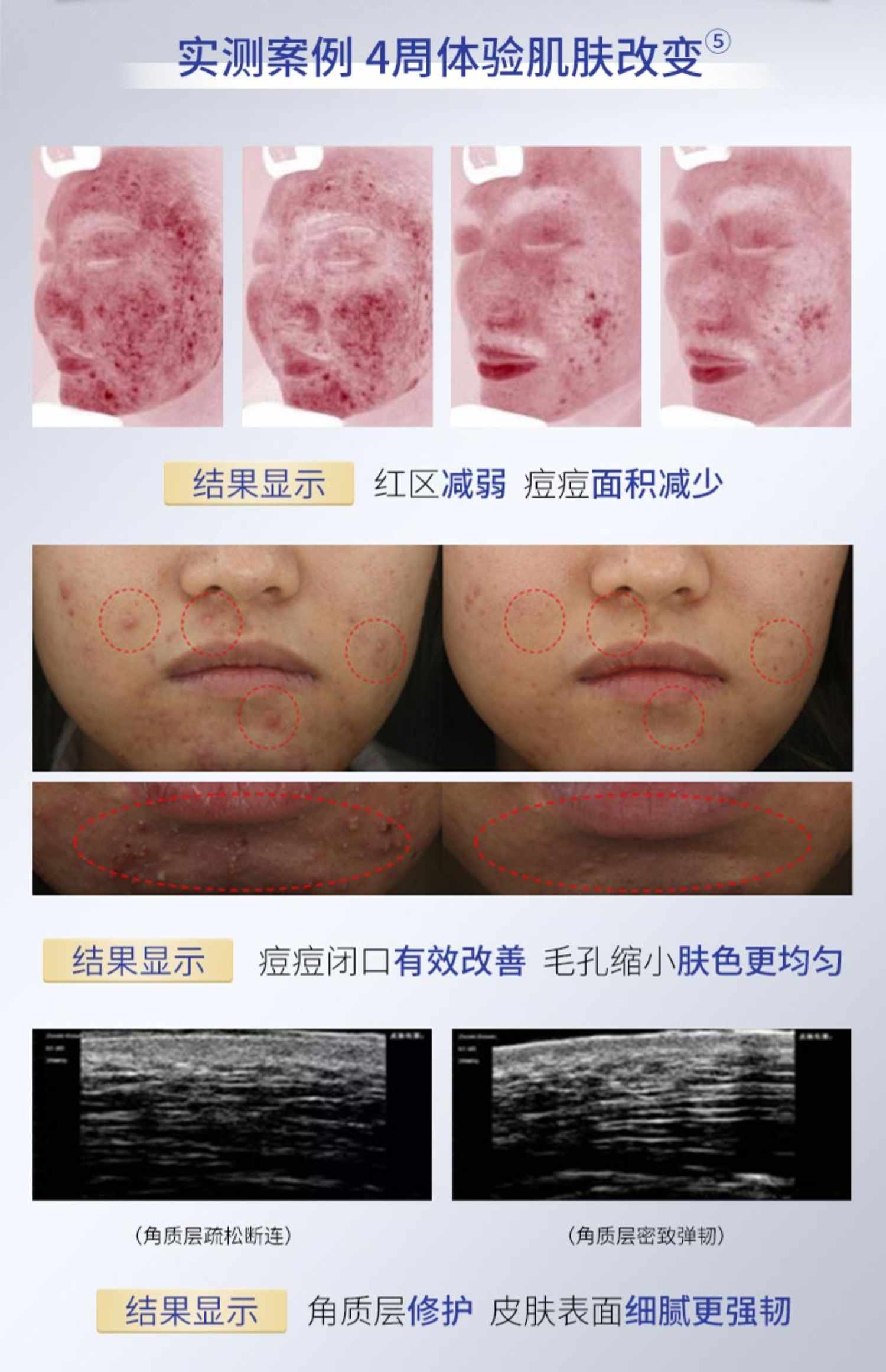 博乐达水杨酸祛痘去黑头去闭口粉刺控油清洁细腻收缩毛孔涂抹面膜