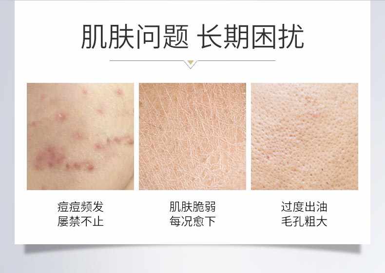 博乐达水杨酸祛痘去黑头去闭口粉刺控油清洁细腻收缩毛孔涂抹面膜