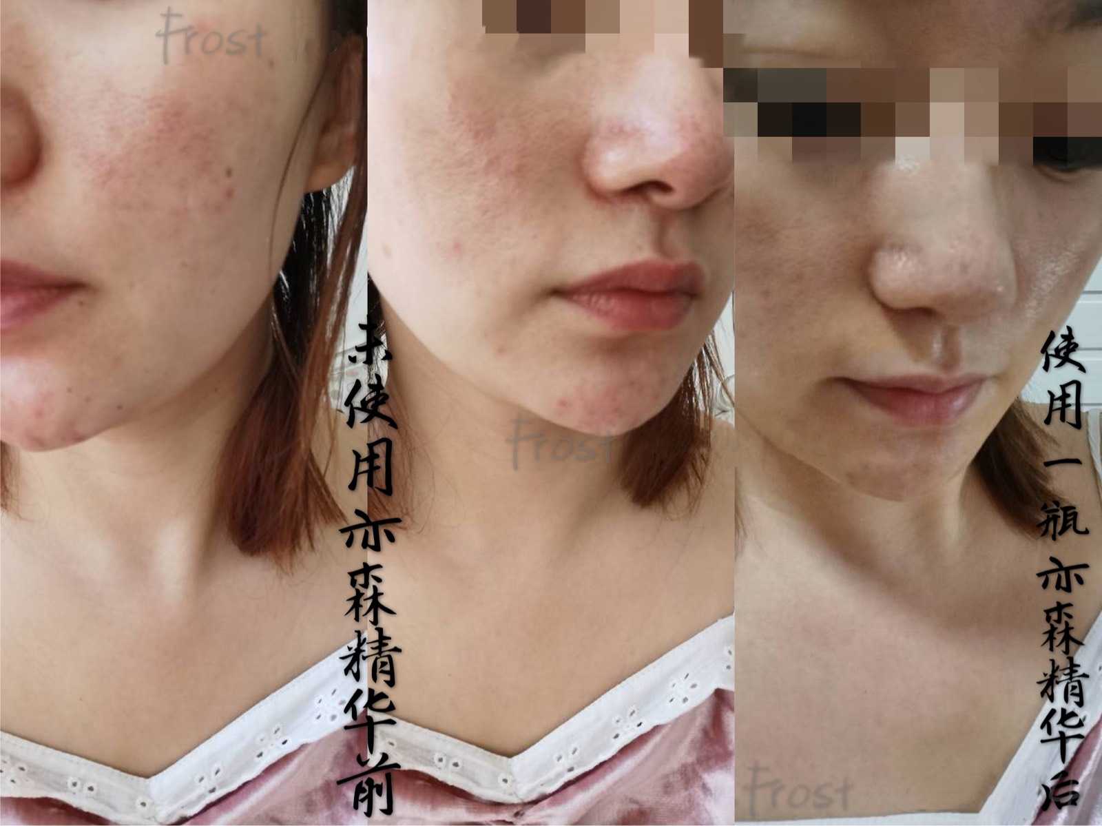 奕森祛痘精华液修颜源码20ml仪痤疮粉刺黑头痘印弈森水凝胶正品