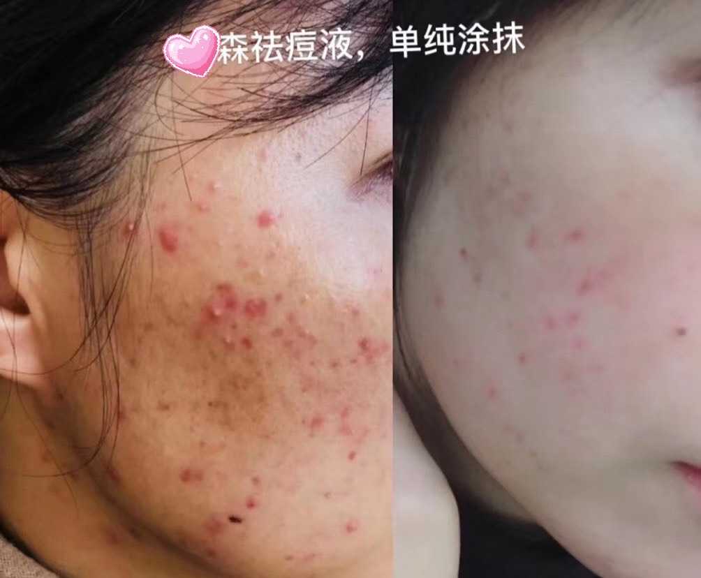 奕森祛痘精华液修颜源码20ml仪痤疮粉刺黑头痘印弈森水凝胶正品