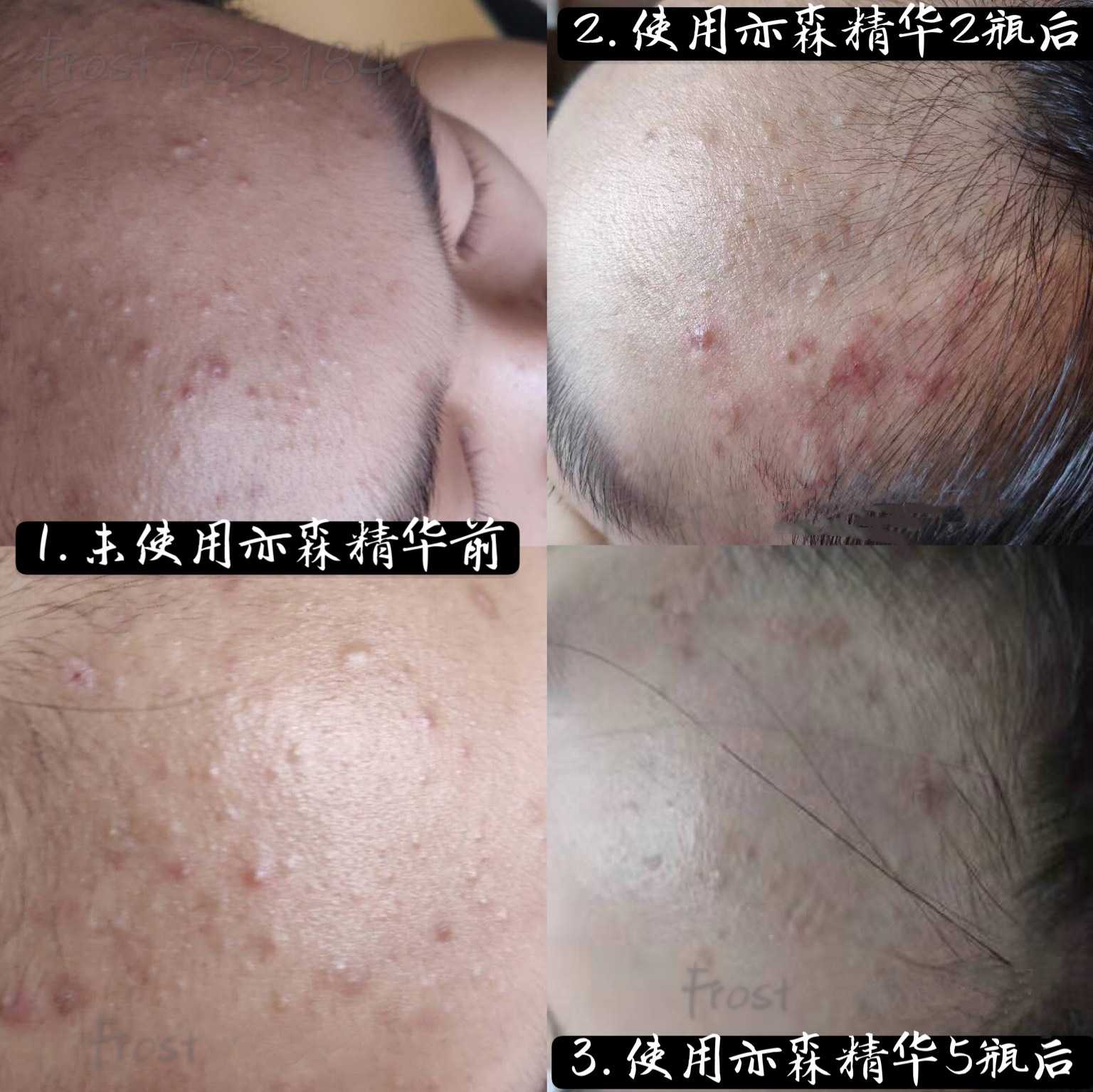 奕森祛痘精华液修颜源码20ml仪痤疮粉刺黑头痘印弈森水凝胶正品