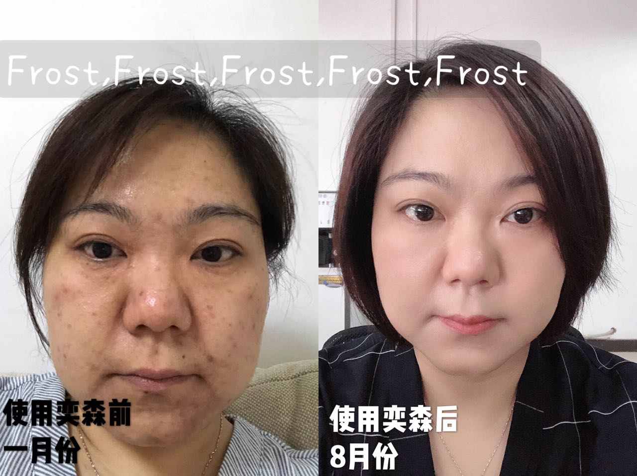 奕森祛痘精华液修颜源码20ml仪痤疮粉刺黑头痘印弈森水凝胶正品