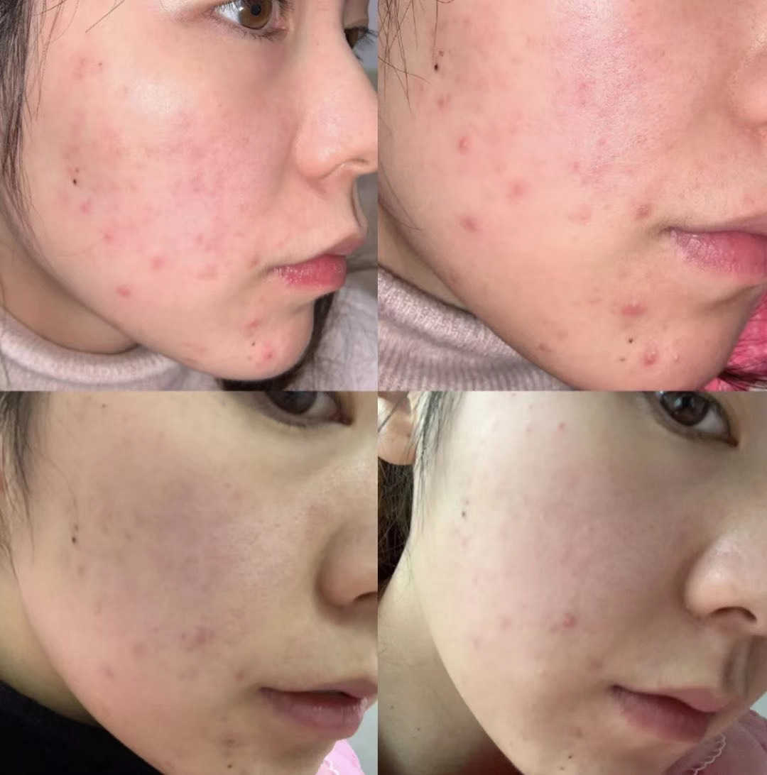 奕森祛痘精华液修颜源码20ml仪痤疮粉刺黑头痘印弈森水凝胶正品